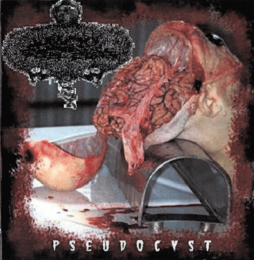 Urinary Tract Infection From Severe Pus Clots : Pseudocyst